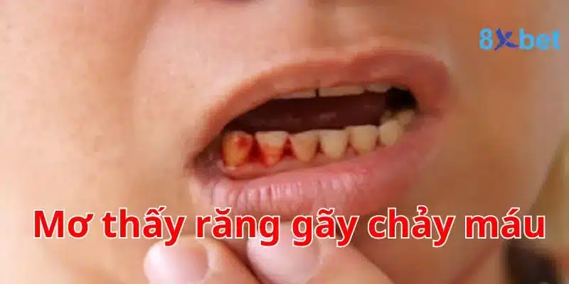 Giải mã giấc mơ, nằm mơ thấy máu nên đánh số nào? Mơ thấy răng gãy chảy máu